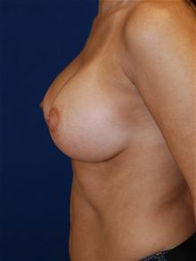 Breast Augmentation After Photo by Michael Eisemann, MD; Houston, TX - Case 27677