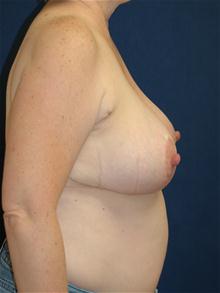 Breast Reduction After Photo by Michael Eisemann, MD; Houston, TX - Case 27685