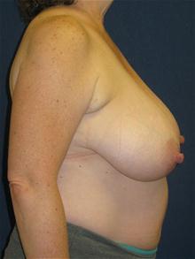 Breast Reduction Before Photo by Michael Eisemann, MD; Houston, TX - Case 27685