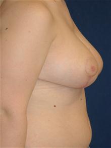 Breast Reduction After Photo by Michael Eisemann, MD; Houston, TX - Case 27688