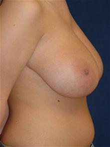 Breast Reduction Before Photo by Michael Eisemann, MD; Houston, TX - Case 27688