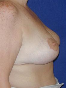 Breast Reduction After Photo by Michael Eisemann, MD; Houston, TX - Case 27689