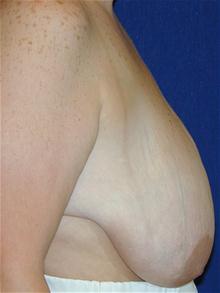 Breast Reduction Before Photo by Michael Eisemann, MD; Houston, TX - Case 27689
