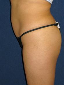 Liposuction After Photo by Michael Eisemann, MD; Houston, TX - Case 27692