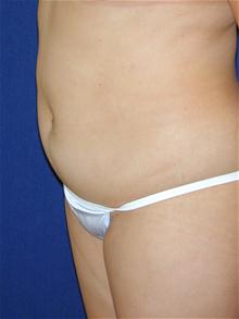 Liposuction Before Photo by Michael Eisemann, MD; Houston, TX - Case 27692