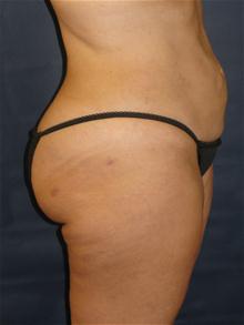 Liposuction After Photo by Michael Eisemann, MD; Houston, TX - Case 27694