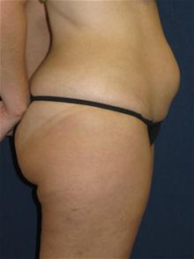 Liposuction Before Photo by Michael Eisemann, MD; Houston, TX - Case 27694