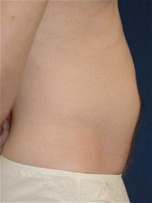 Liposuction After Photo by Michael Eisemann, MD; Houston, TX - Case 27696