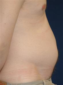 Liposuction Before Photo by Michael Eisemann, MD; Houston, TX - Case 27696