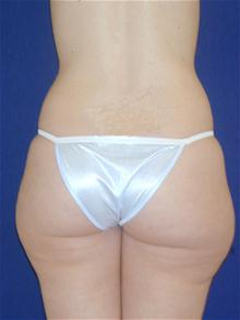 Liposuction Before Photo by Michael Eisemann, MD; Houston, TX - Case 27697