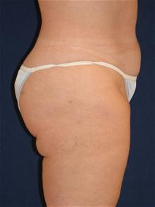 Liposuction After Photo by Michael Eisemann, MD; Houston, TX - Case 27698