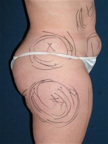 Liposuction Before Photo by Michael Eisemann, MD; Houston, TX - Case 27698