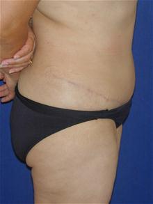 Tummy Tuck After Photo by Michael Eisemann, MD; Houston, TX - Case 27702