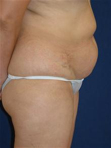 Tummy Tuck Before Photo by Michael Eisemann, MD; Houston, TX - Case 27702