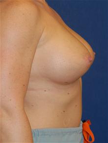 Breast Augmentation After Photo by Michael Eisemann, MD; Houston, TX - Case 27705