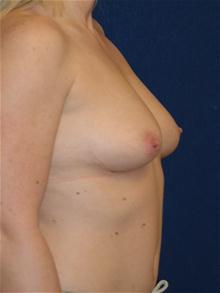Breast Augmentation Before Photo by Michael Eisemann, MD; Houston, TX - Case 27705