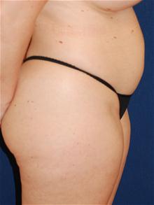 Liposuction Before Photo by Michael Eisemann, MD; Houston, TX - Case 27709