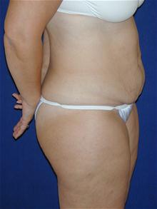 Tummy Tuck Before Photo by Michael Eisemann, MD; Houston, TX - Case 27710