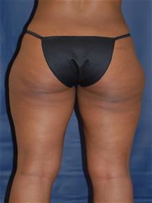 Liposuction After Photo by Michael Eisemann, MD; Houston, TX - Case 27712