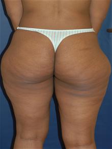 Liposuction Before Photo by Michael Eisemann, MD; Houston, TX - Case 27712