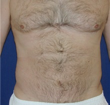 Liposuction After Photo by Michael Eisemann, MD; Houston, TX - Case 27932