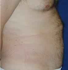 Liposuction After Photo by Michael Eisemann, MD; Houston, TX - Case 27932