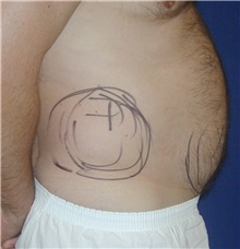 Liposuction Before Photo by Michael Eisemann, MD; Houston, TX - Case 27932