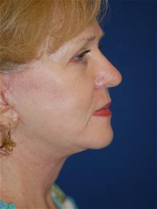 Facelift After Photo by Michael Eisemann, MD; Houston, TX - Case 28473