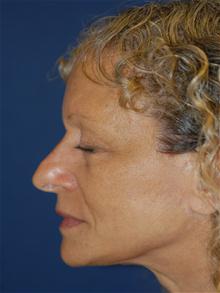 Facelift After Photo by Michael Eisemann, MD; Houston, TX - Case 28480