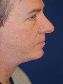 Facelift After Photo by Michael Eisemann, MD; Houston, TX - Case 28553