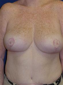 Breast Reduction After Photo by Michael Eisemann, MD; Houston, TX - Case 28719