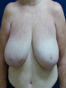 Breast Reduction Before Photo by Michael Eisemann, MD; Houston, TX - Case 28719