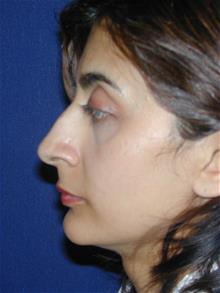 Rhinoplasty Before Photo by Michael Eisemann, MD; Houston, TX - Case 28723