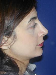 Rhinoplasty After Photo by Michael Eisemann, MD; Houston, TX - Case 28723