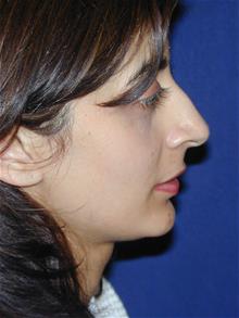Rhinoplasty Before Photo by Michael Eisemann, MD; Houston, TX - Case 28723