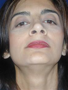 Rhinoplasty After Photo by Michael Eisemann, MD; Houston, TX - Case 28723