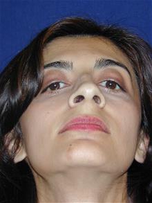 Rhinoplasty Before Photo by Michael Eisemann, MD; Houston, TX - Case 28723