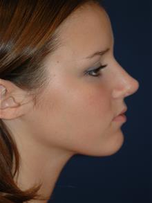 Rhinoplasty After Photo by Michael Eisemann, MD; Houston, TX - Case 28729