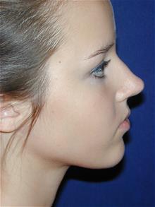 Rhinoplasty Before Photo by Michael Eisemann, MD; Houston, TX - Case 28729