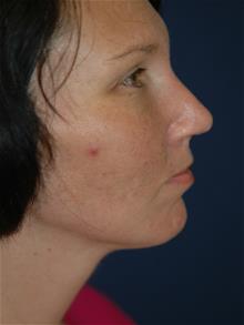 Rhinoplasty After Photo by Michael Eisemann, MD; Houston, TX - Case 28731