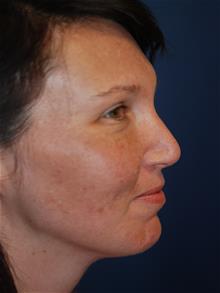 Rhinoplasty Before Photo by Michael Eisemann, MD; Houston, TX - Case 28731
