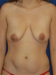 Breast Augmentation Before Photo by Michael Eisemann, MD; Houston, TX - Case 28815