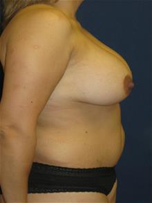 Breast Augmentation After Photo by Michael Eisemann, MD; Houston, TX - Case 28815