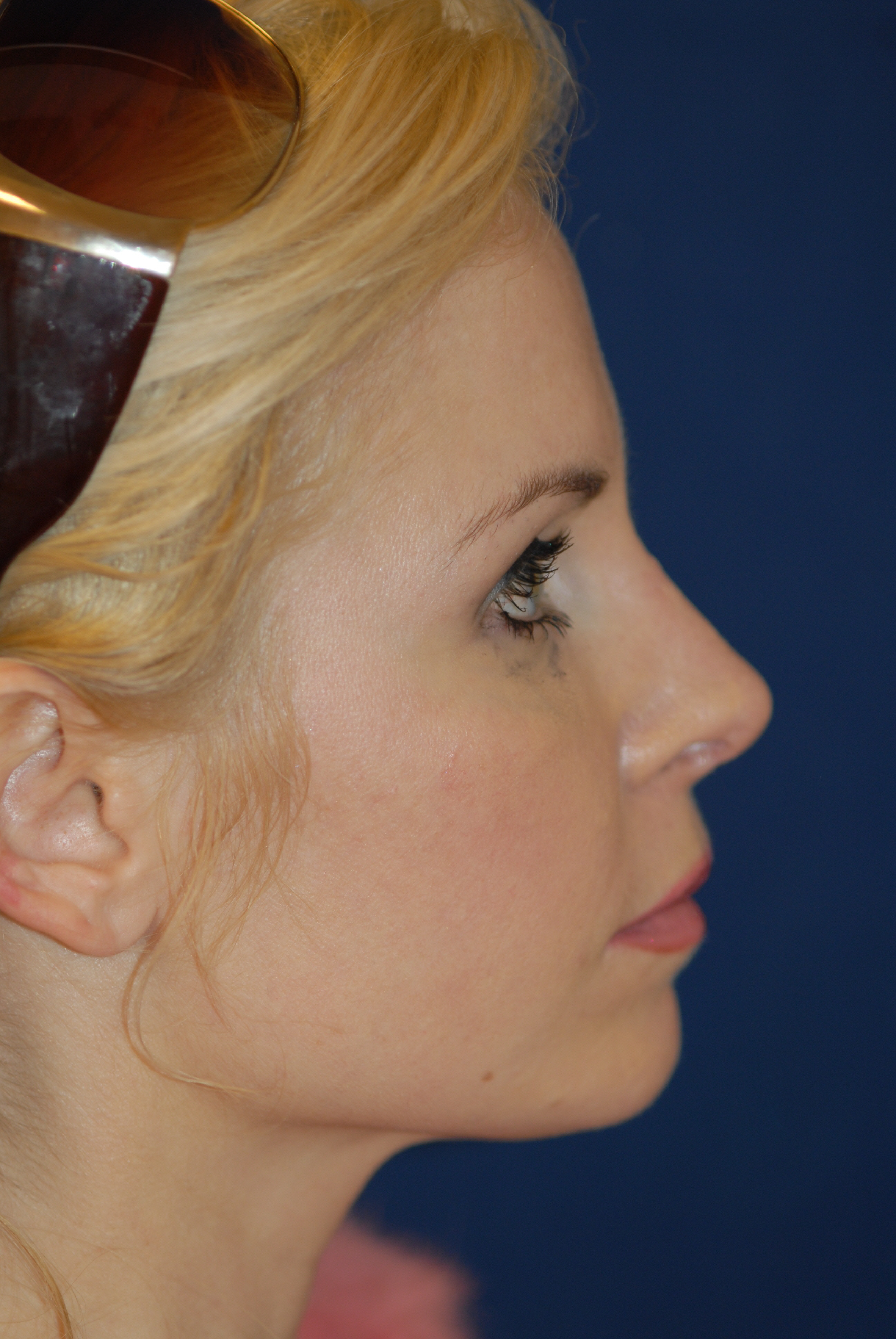 Rhinoplasty Before and After Photos by Michael Eisemann, MD; Houston, TX Case 28822 ASPS