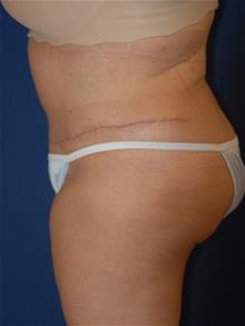 Tummy Tuck After Photo by Michael Eisemann, MD; Houston, TX - Case 28828