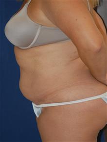 Tummy Tuck Before Photo by Michael Eisemann, MD; Houston, TX - Case 28828