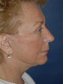 Facelift After Photo by Michael Eisemann, MD; Houston, TX - Case 28853