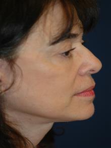 Facelift After Photo by Michael Eisemann, MD; Houston, TX - Case 28858