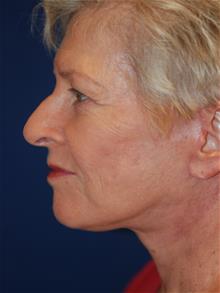 Facelift After Photo by Michael Eisemann, MD; Houston, TX - Case 28859