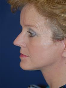 Facelift After Photo by Michael Eisemann, MD; Houston, TX - Case 28860